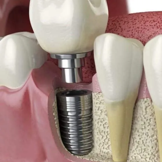 Diagram of a dental implant