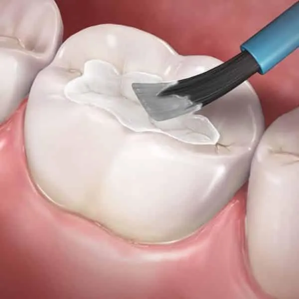 Dental sealant being applied to a tooth