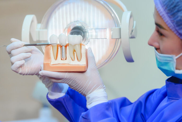 Why Dental Implants Might Be the Best Investment You Make in Your Smile